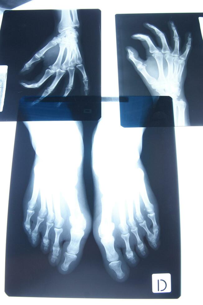two x - rays of the hand showing the fingers photo