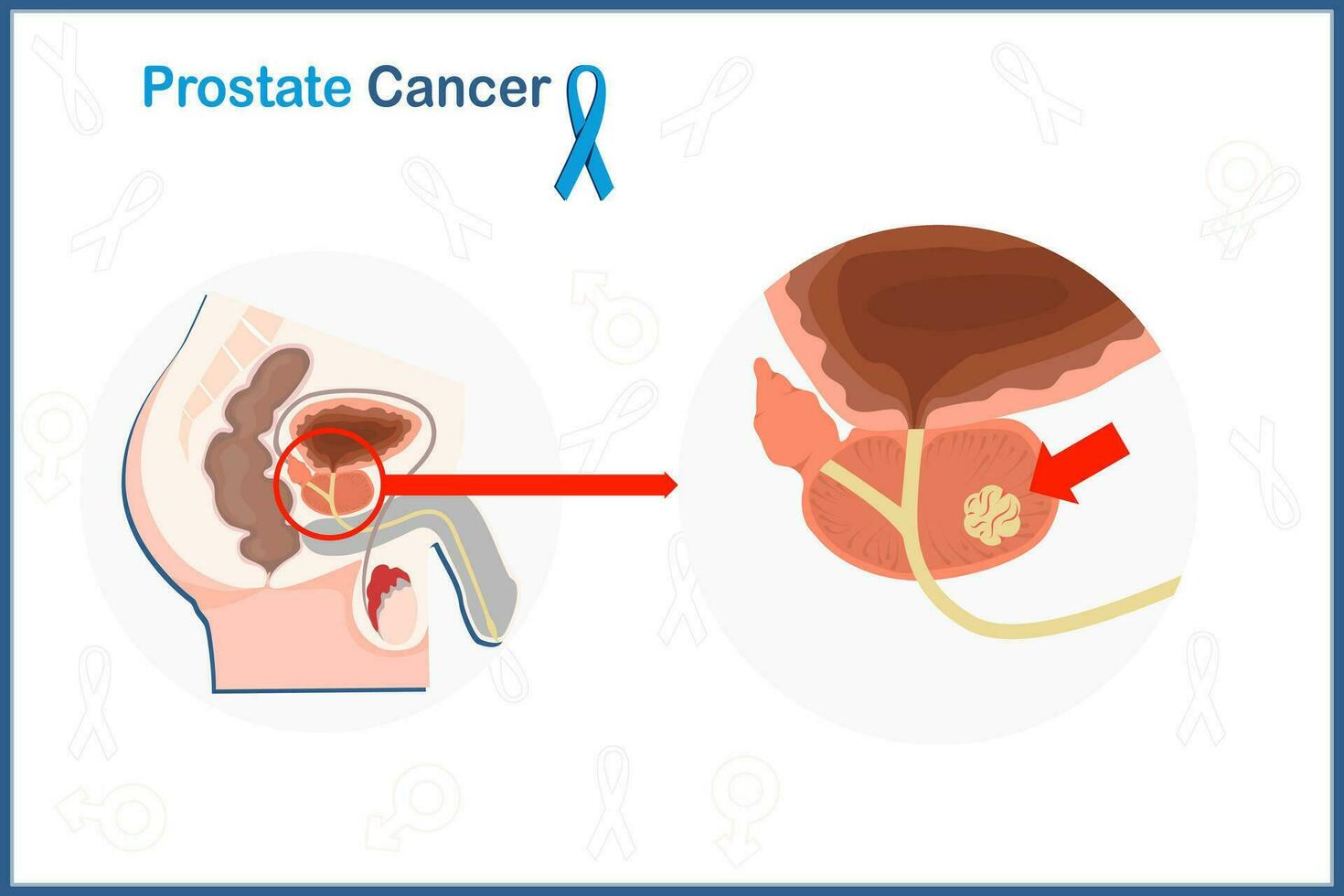 Flat medical illustration concept of prostate cancer. Male reproductive system and prostate cancer. vector