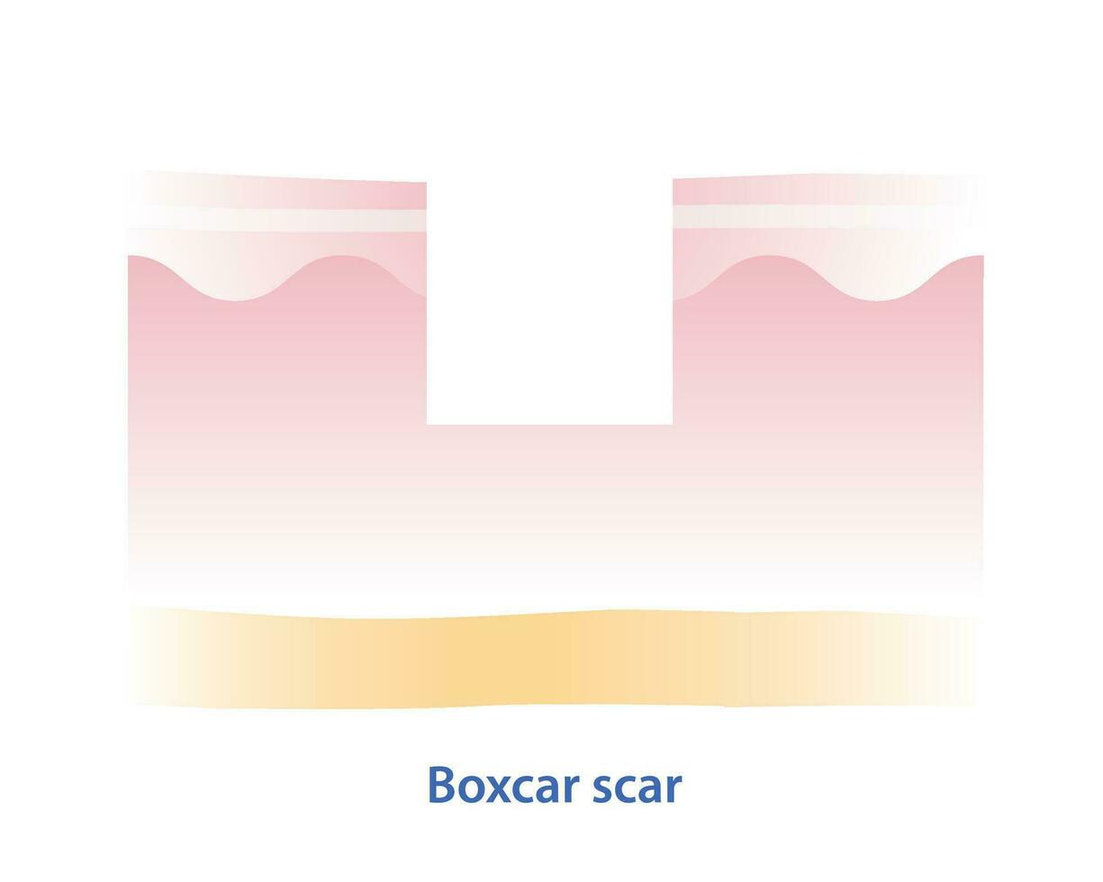 Cross section of boxcar scar vector illustration isolated on white background. Boxcar scar, atrophic scar, type of acne scar on skin surface. Skin care and beauty concept.