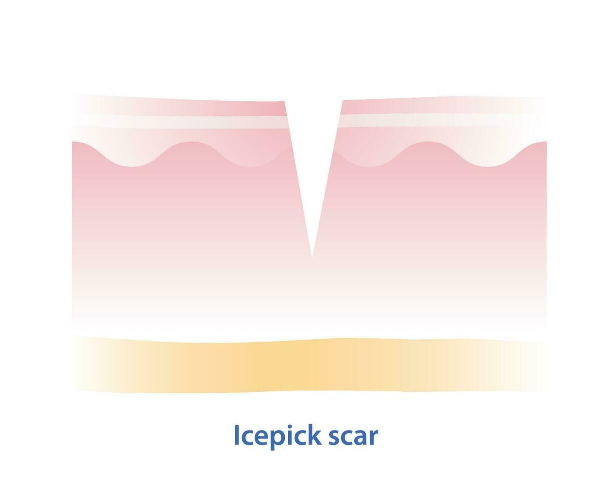 Cross section of icepick scar vector illustration isolated on white background. Icepick scar, atrophic scar, type of acne scar on skin surface. Skin care and beauty concept.