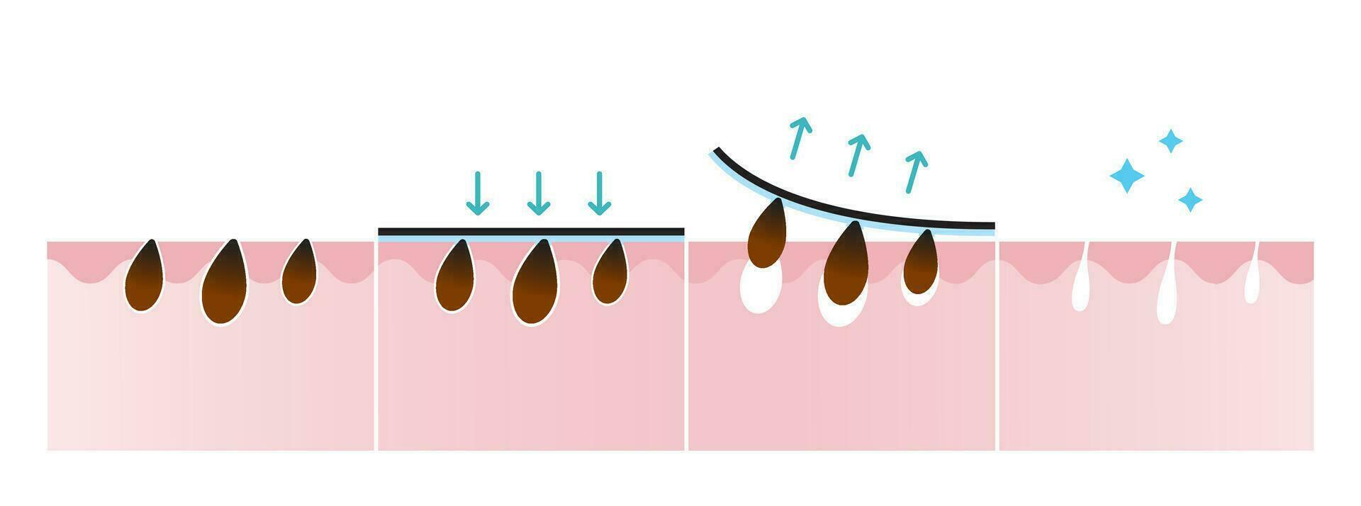 Blackhead removal process vector illustration isolated on white background. Cross section of  blackhead pore strip treatment, apply, peel off, unclogging and tighten pores. Before and after concept.