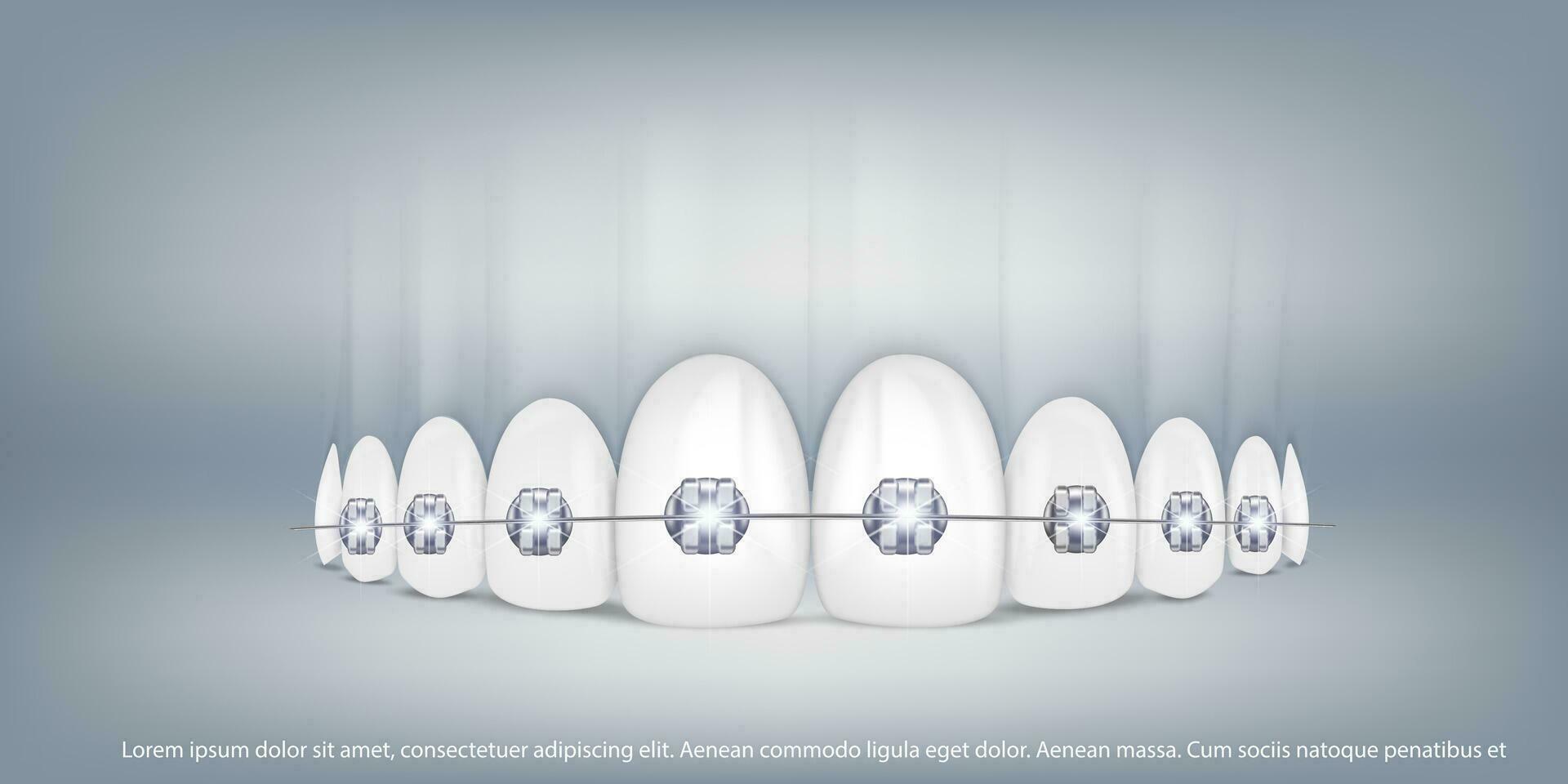 3d vector illustration, realistic teeth with braces upper and lower jaw. Alignment of the bite of teeth, dentition with braces, dental braces.