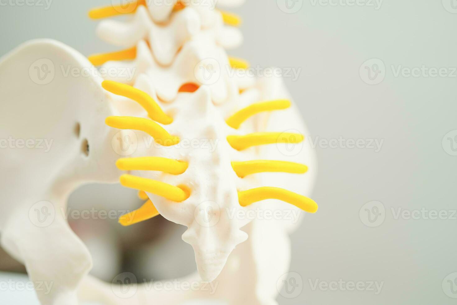 Spinal nerve and bone, Lumbar spine displaced herniated disc fragment, Model for treatment medical in the orthopedic department. photo