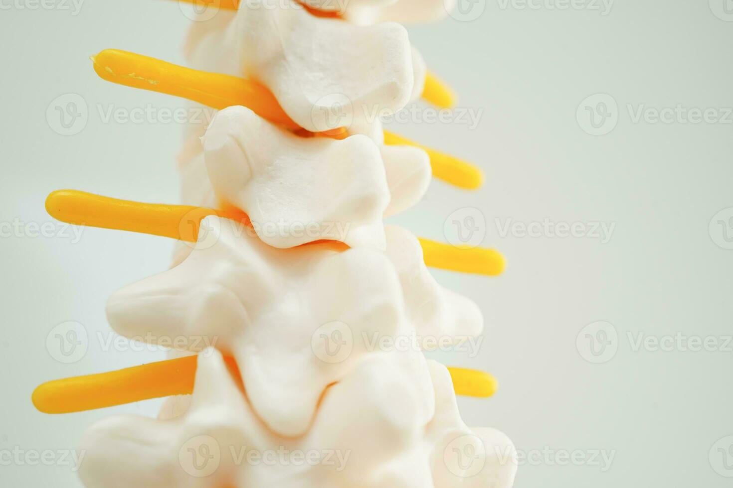 Spinal nerve and bone, Lumbar spine displaced herniated disc fragment, Model for treatment medical in the orthopedic department. photo