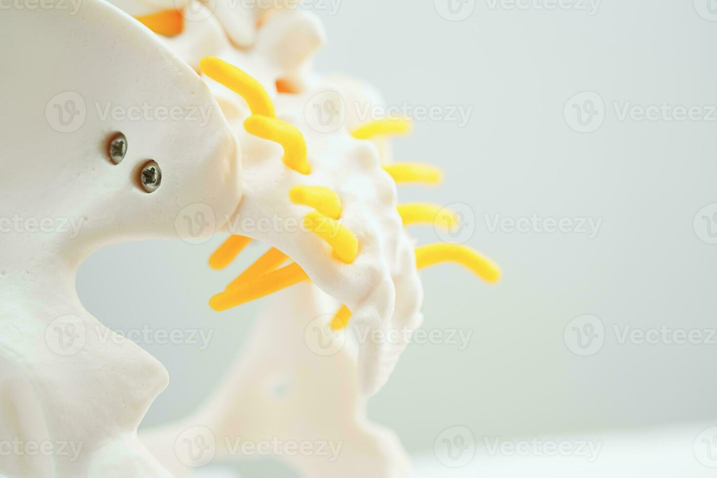 Spinal nerve and bone, Lumbar spine displaced herniated disc fragment, Model for treatment medical in the orthopedic department. photo