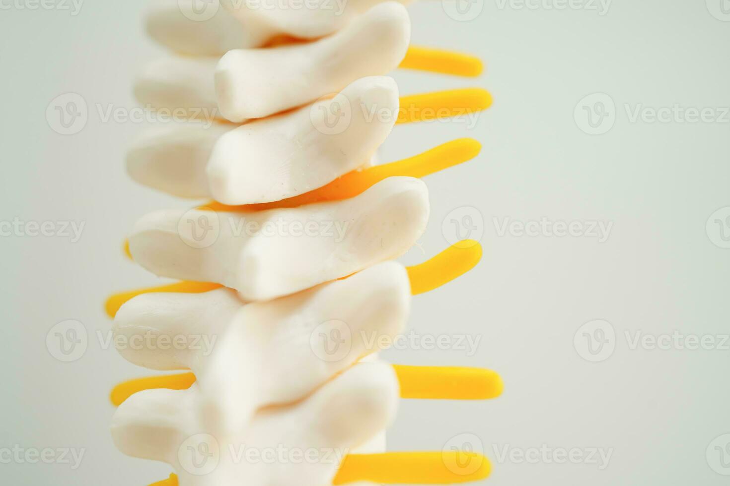 Spinal nerve and bone, Lumbar spine displaced herniated disc fragment, Model for treatment medical in the orthopedic department. photo