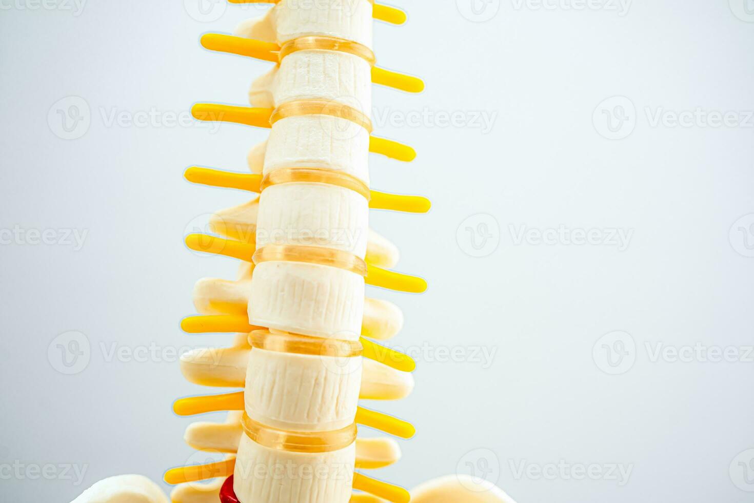 Lumbar spine displaced herniated disc fragment, spinal nerve and bone. Model for treatment medical in the orthopedic department. photo