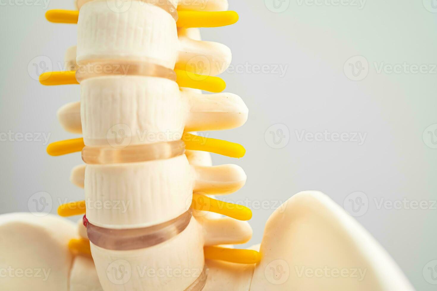 Lumbar spine displaced herniated disc fragment, spinal nerve and bone. Model for treatment medical in the orthopedic department. photo