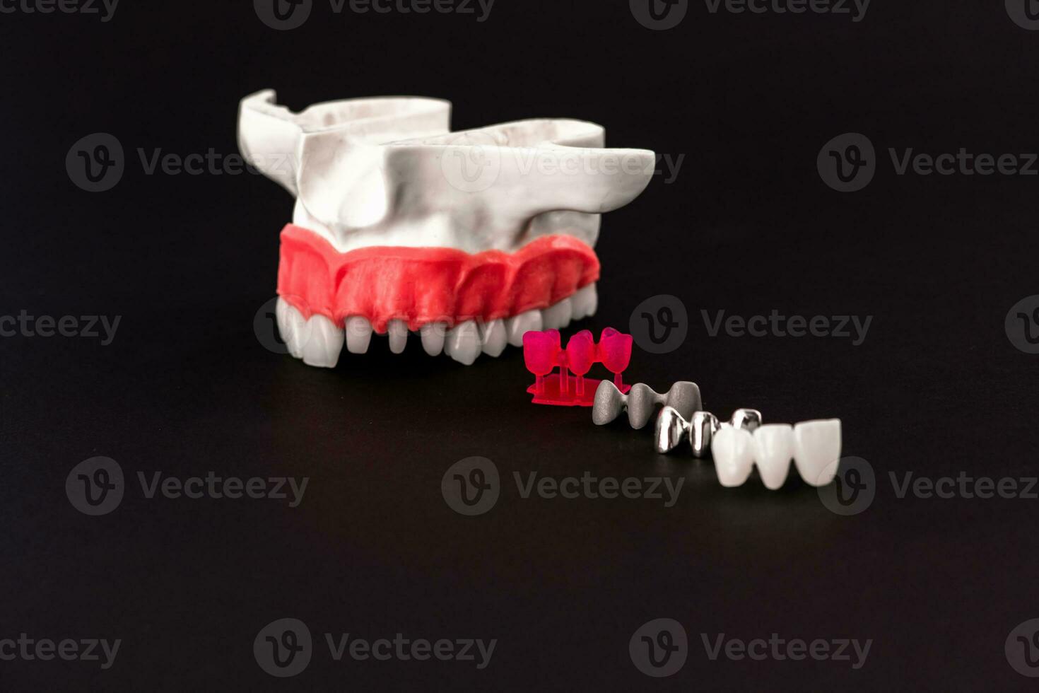 Teeth implant and crown installation process parts isolated on a black background. Medically accurate 3D model. photo