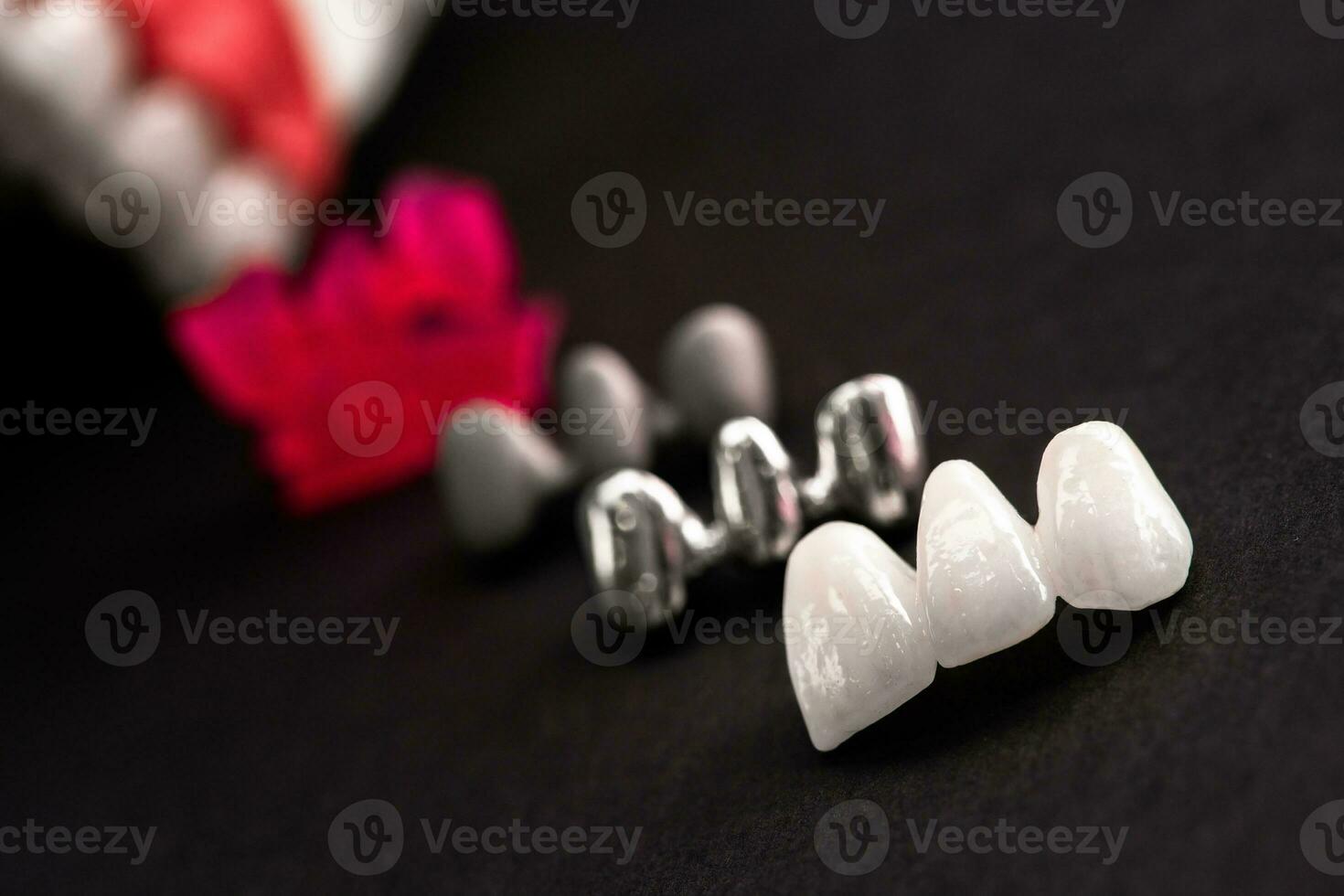 Teeth implant and crown installation process parts isolated on a black background. Medically accurate 3D model. photo