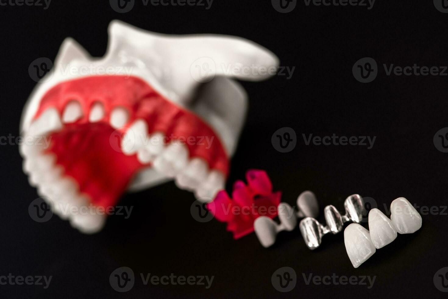 Teeth implant and crown installation process parts isolated on a black background. Medically accurate 3D model. photo