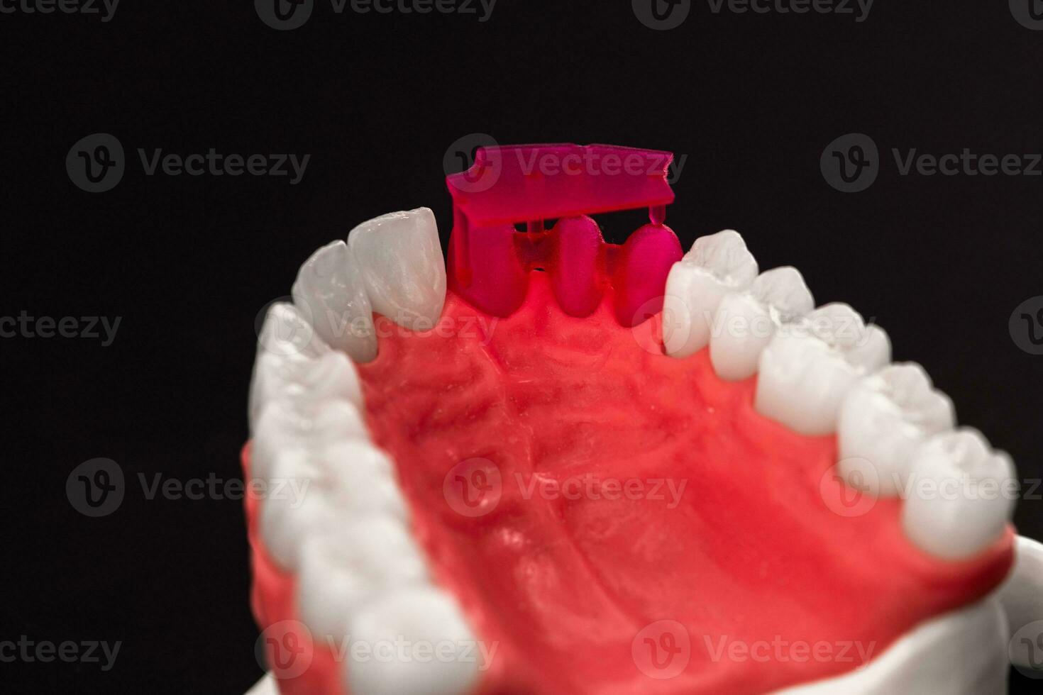 Teeth implant and crown installation process parts isolated on a blue background. Medically accurate 3D model. photo