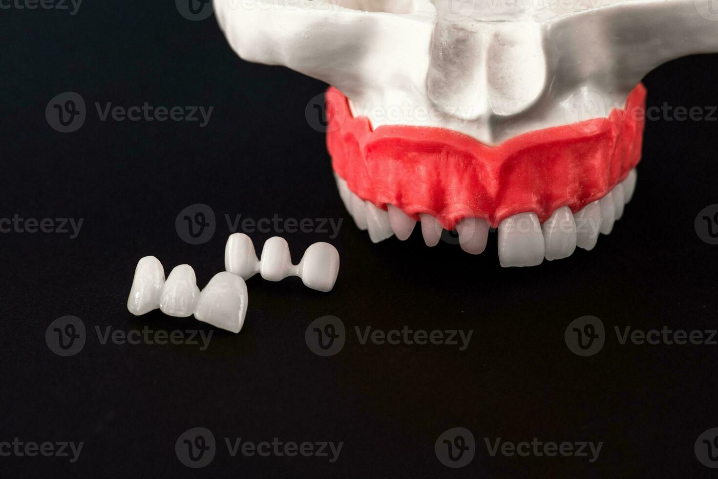 Teeth implant and crown installation process parts isolated on a black background. Medically accurate 3D model. photo
