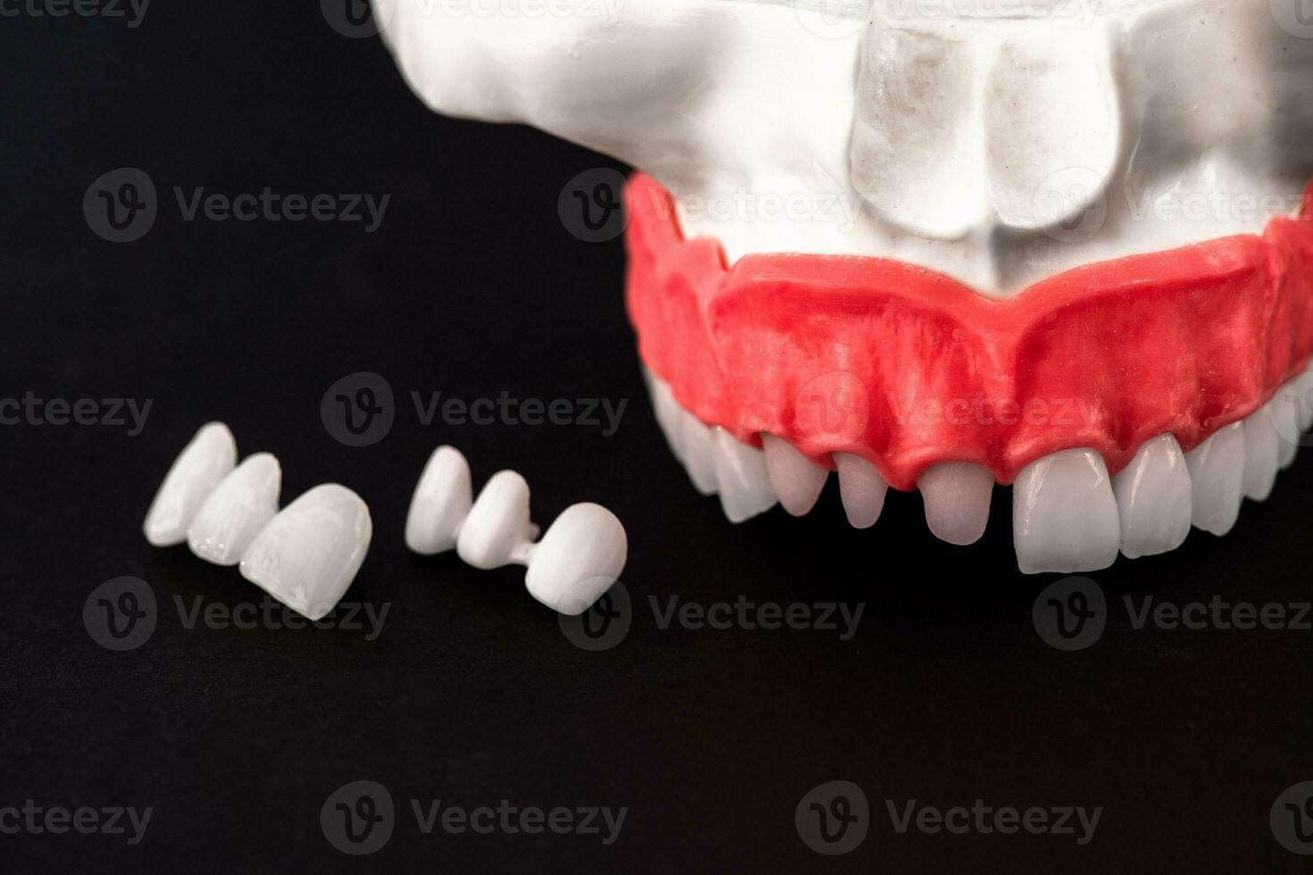 Teeth implant and crown installation process parts isolated on a black background. Medically accurate 3D model. photo