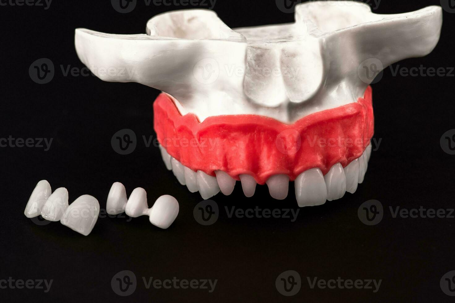 Teeth implant and crown installation process parts isolated on a black background. Medically accurate 3D model. photo