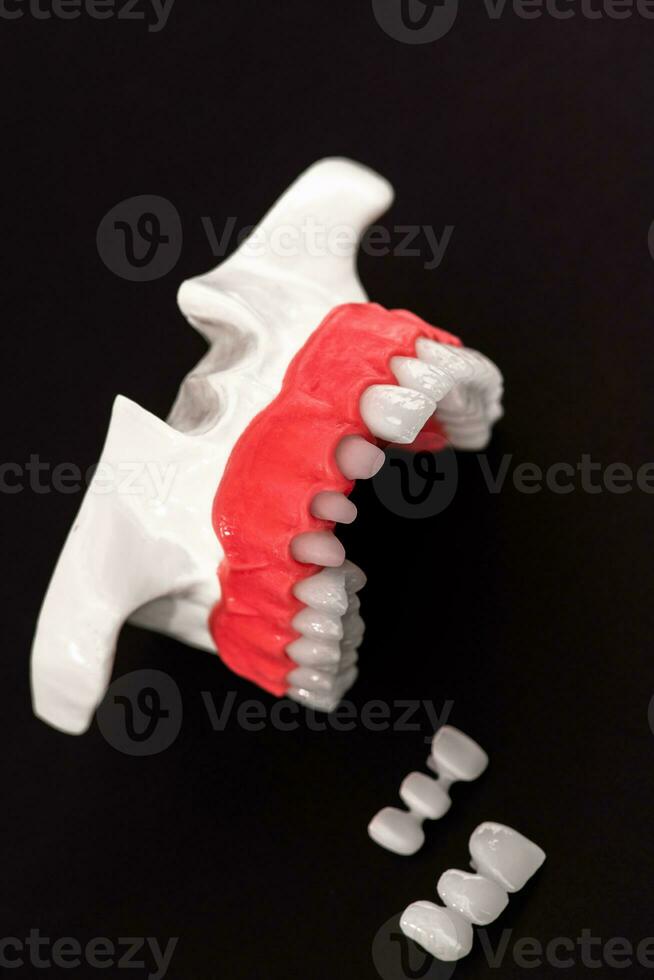 Teeth implant and crown installation process parts isolated on a black background. Medically accurate 3D model. photo