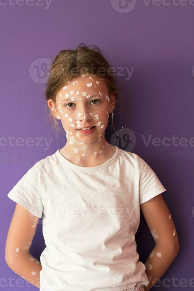 Portrait of a little school girl with chickenpox, antiseptic cream applied to face and body .Colorful background. photo