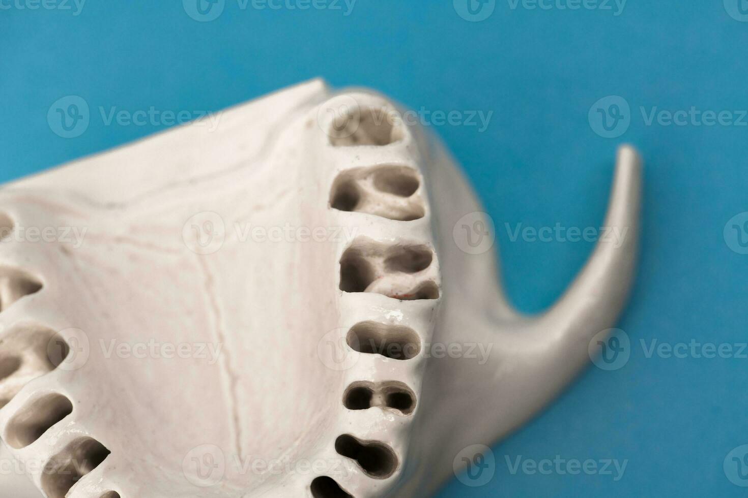 Upper human jaw without teeth model medical implant isolated on blue background. Healthy teeth, dental care and orthodontic concept. photo