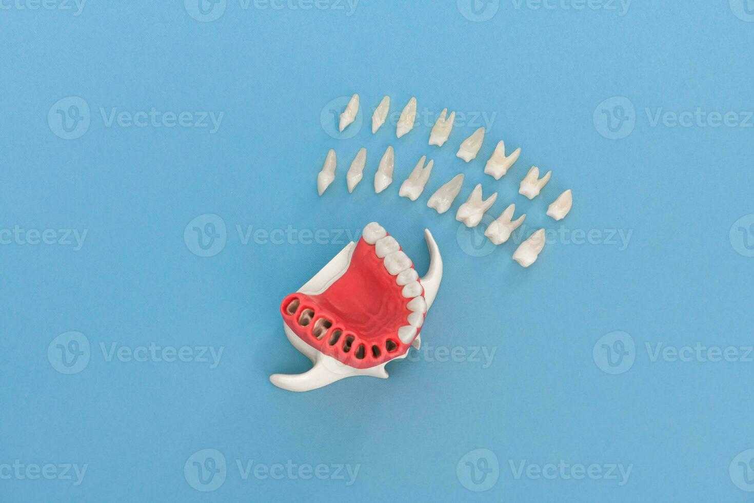 dientes implante y corona instalación proceso partes aislado en un azul antecedentes. médicamente preciso 3d modelo. foto