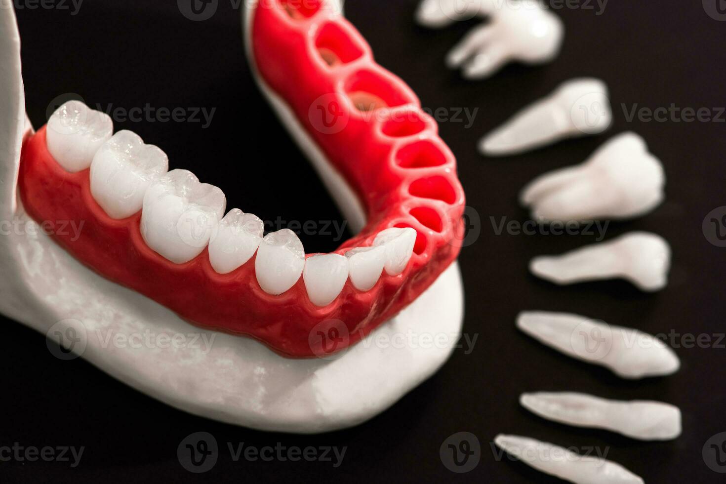 Teeth implant and crown installation process parts isolated on a black background. Medically accurate 3D model. photo