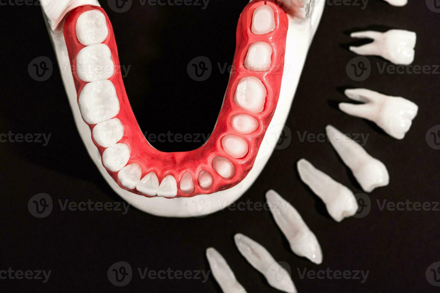 Teeth implant and crown installation process parts isolated on a black background. Medically accurate 3D model. photo