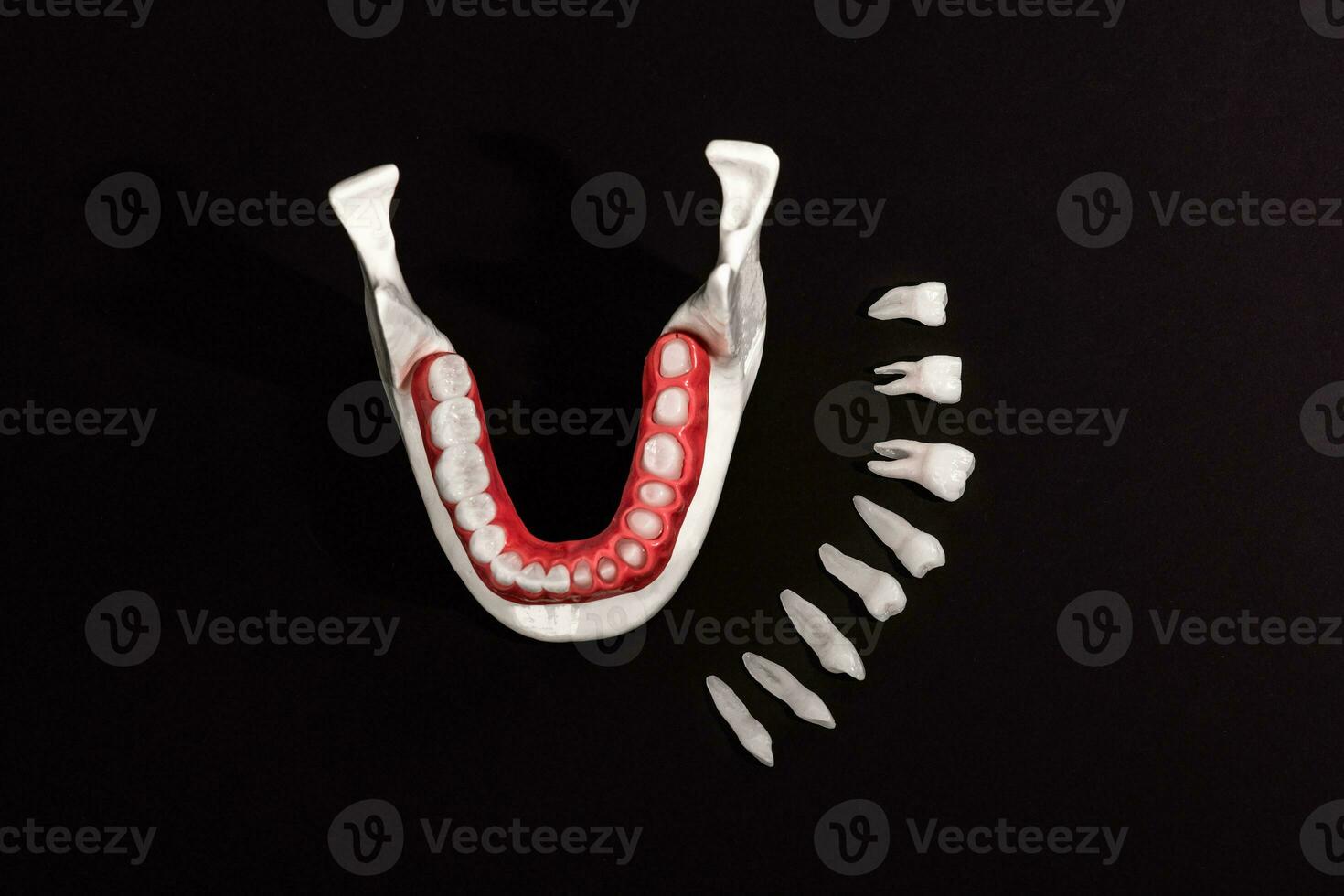 Teeth implant and crown installation process parts isolated on a black background. Medically accurate 3D model. photo