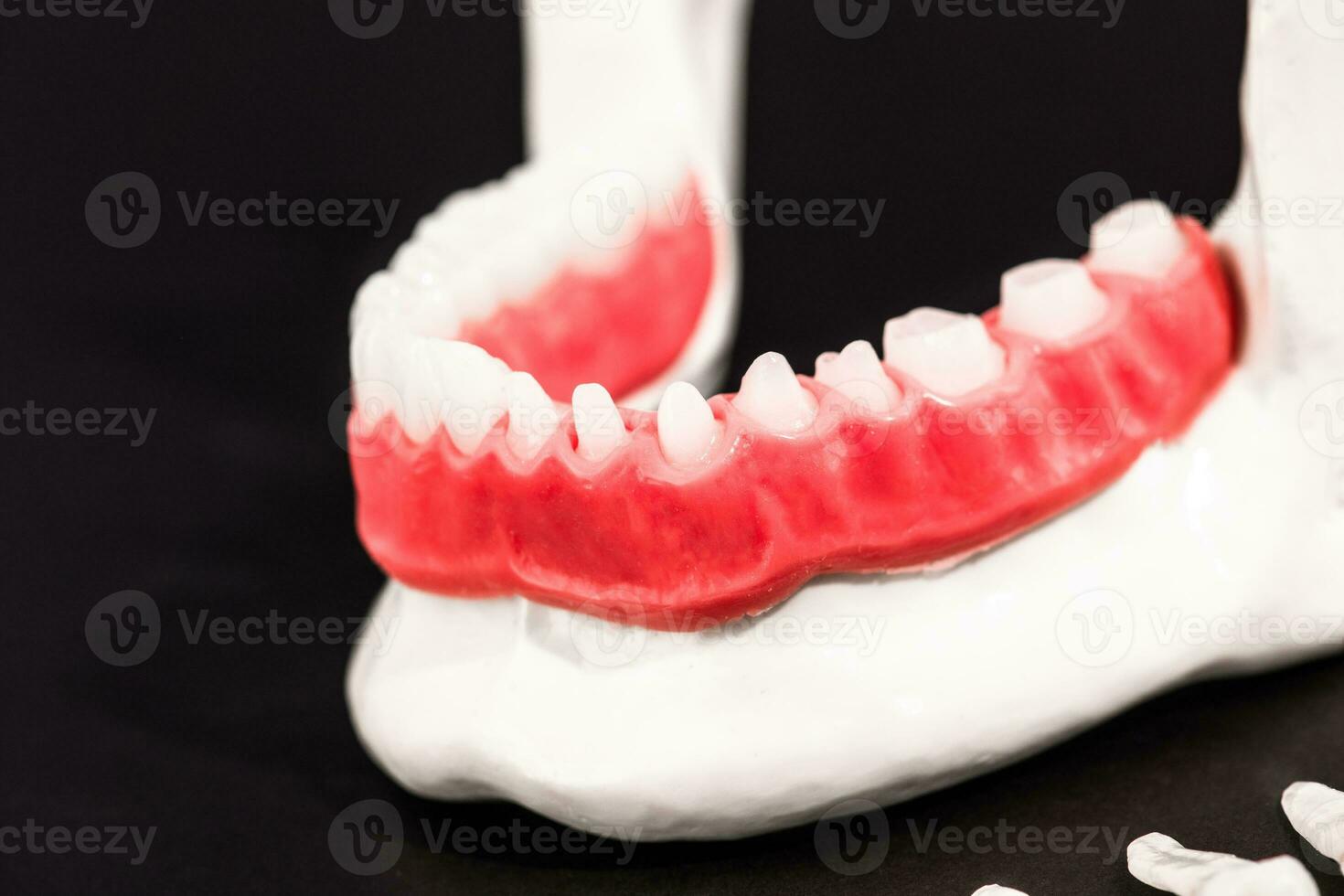 Teeth implant and crown installation process parts isolated on a black background. Medically accurate 3D model. photo