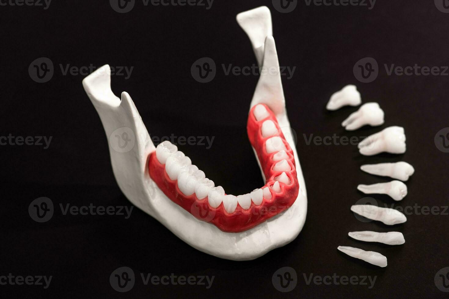 Teeth implant and crown installation process parts isolated on a black background. Medically accurate 3D model. photo