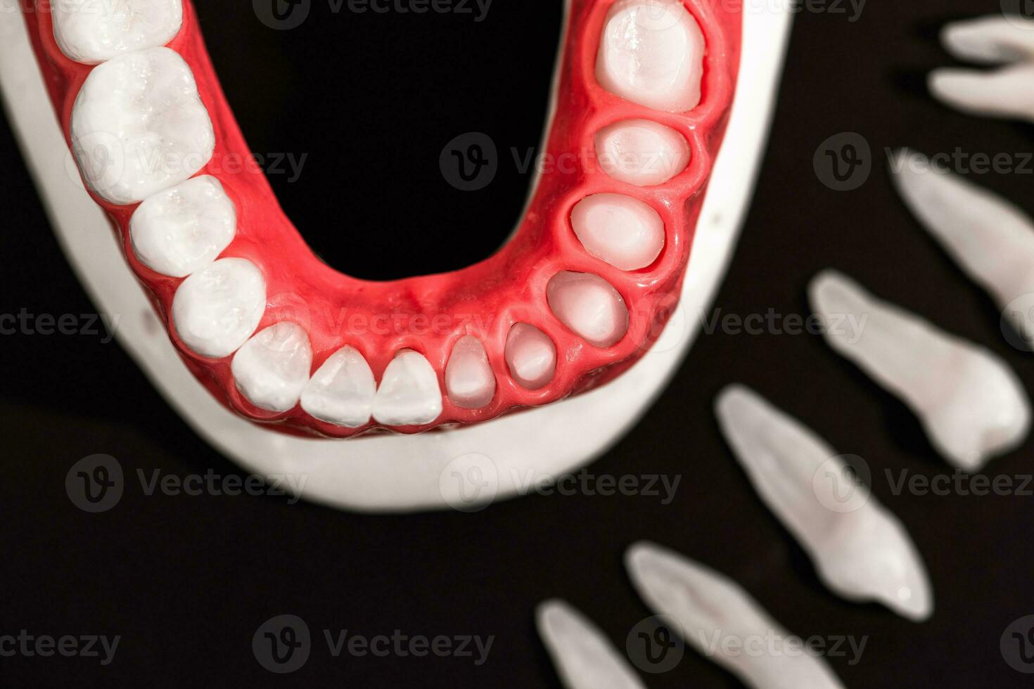 Teeth implant and crown installation process parts isolated on a black background. Medically accurate 3D model. photo
