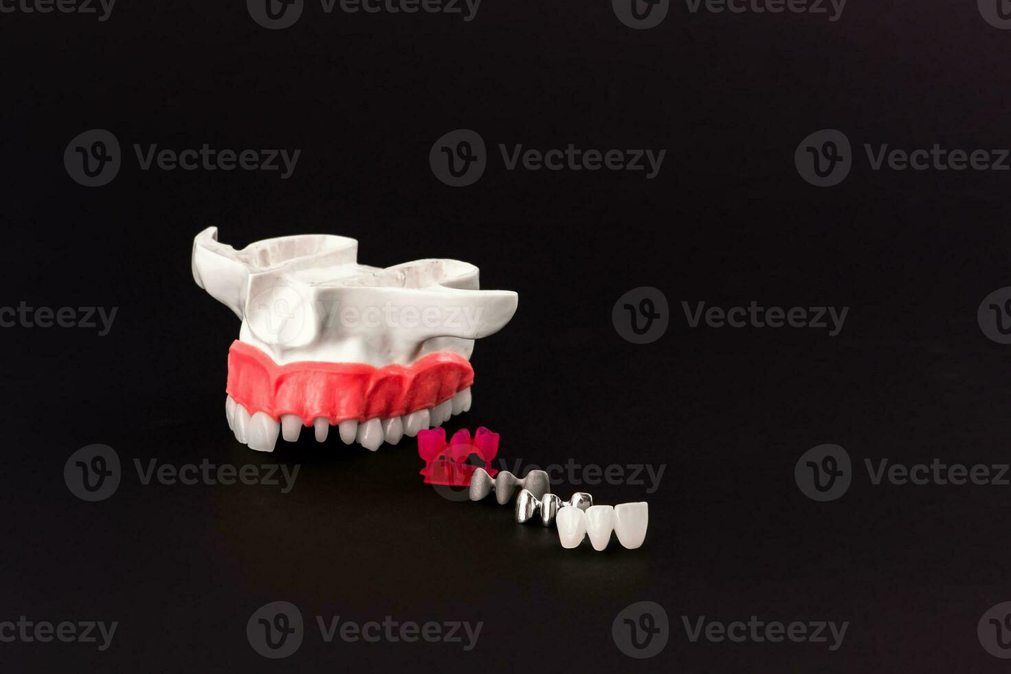 Teeth implant and crown installation process parts isolated on a black background. Medically accurate 3D model. photo