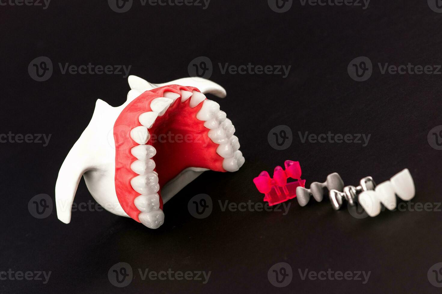 Teeth implant and crown installation process parts isolated on a black background. Medically accurate 3D model. photo