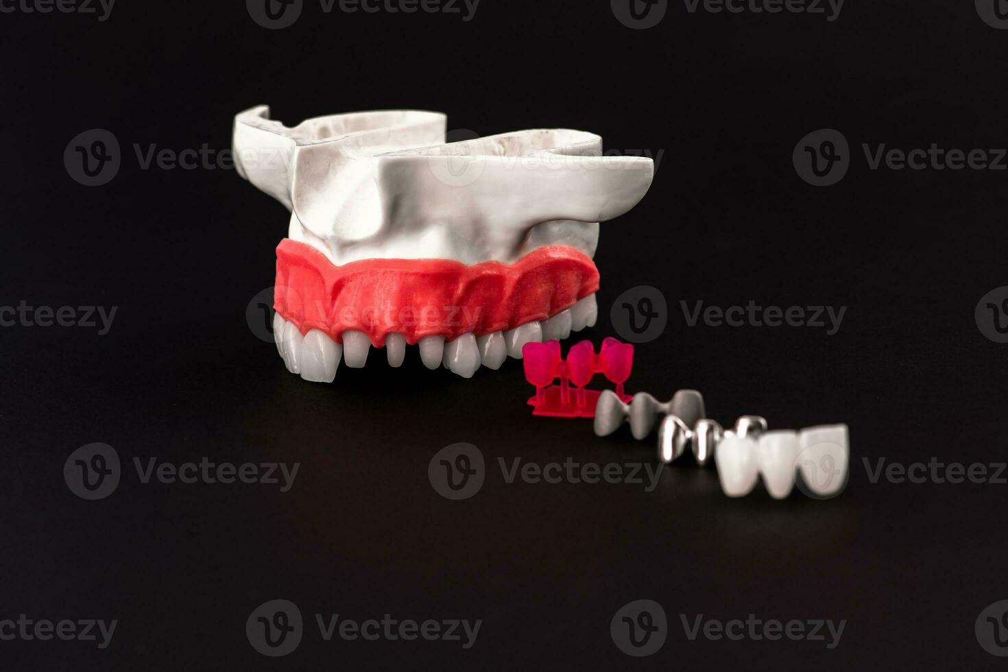 dientes implante y corona instalación proceso partes aislado en un negro antecedentes. médicamente preciso 3d modelo. foto