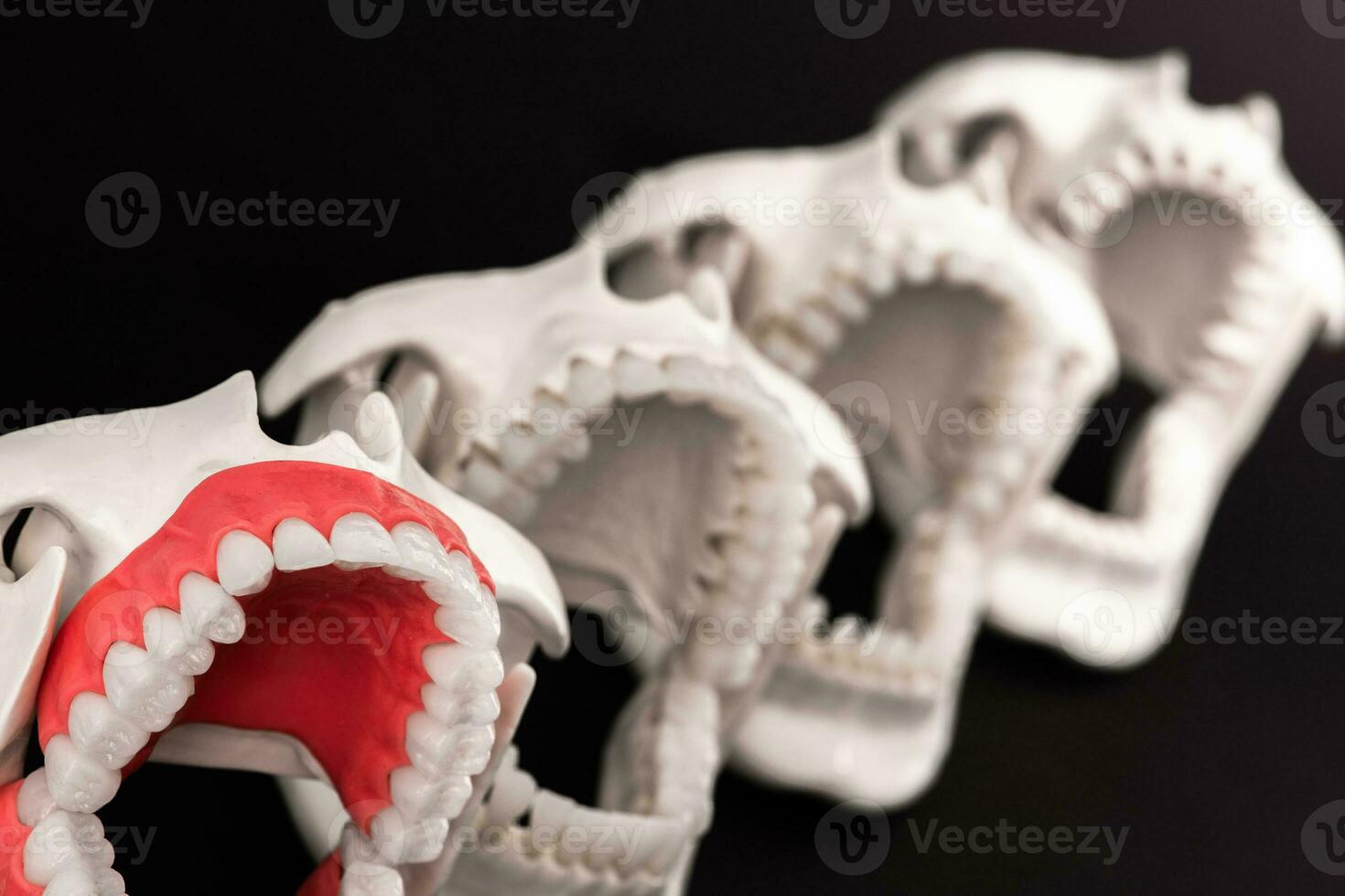 Teeth implant and crown installation process parts isolated on a blue background. Medically accurate 3D model. photo