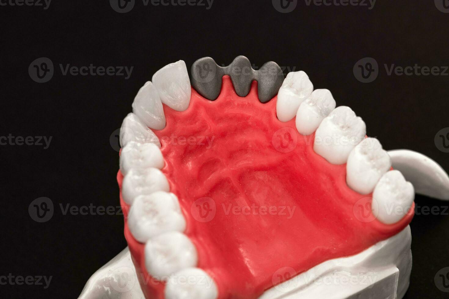 Teeth implant and crown installation process parts isolated on a blue background. Medically accurate 3D model. photo
