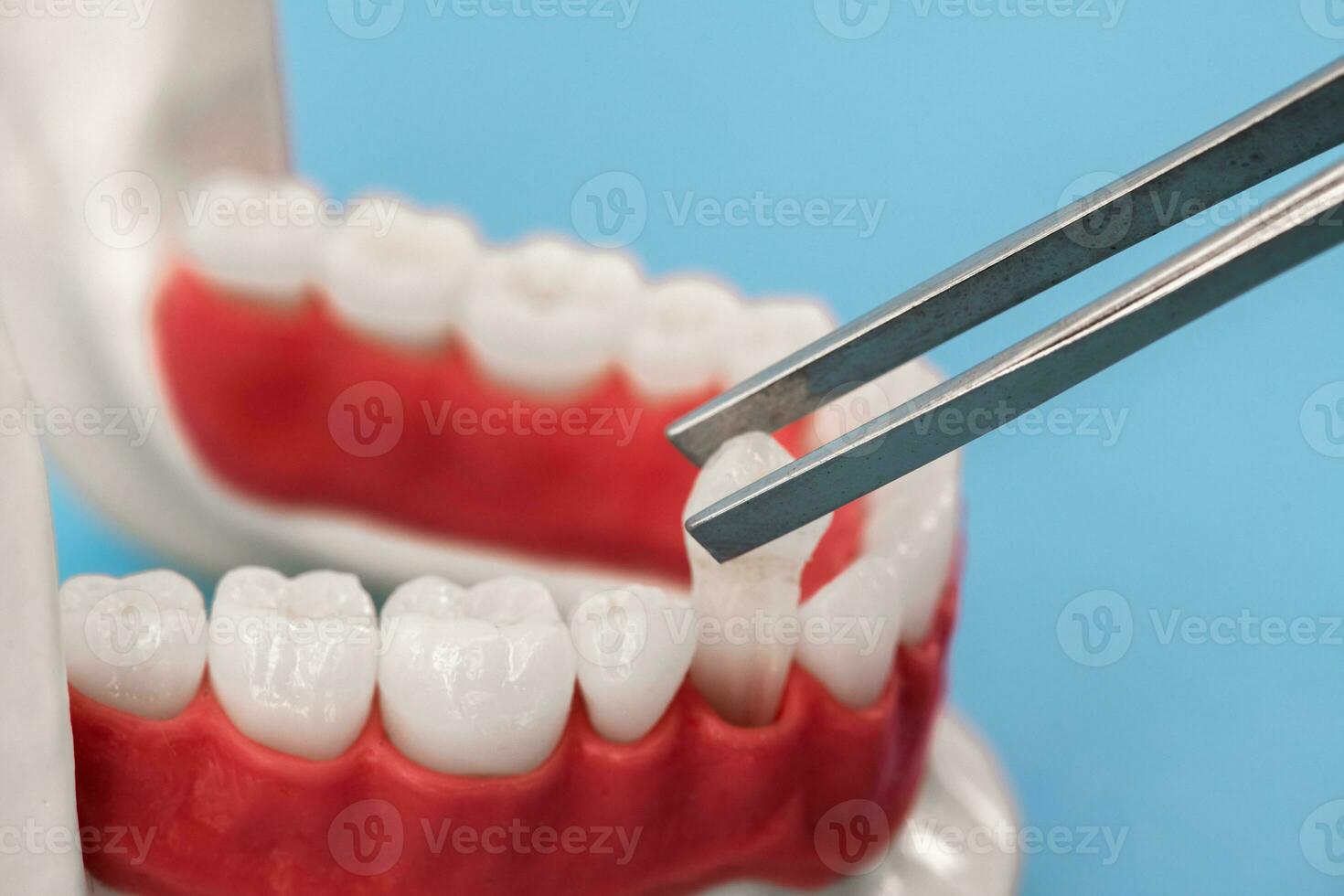 Teeth implant and crown installation process parts isolated on a blue background. Medically accurate 3D model. photo