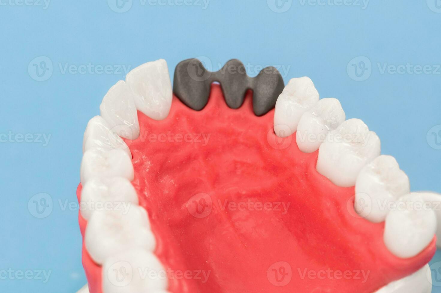 Teeth implant and crown installation process parts isolated on a blue background. Medically accurate 3D model. photo