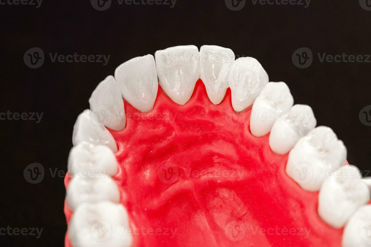 Teeth implant and crown installation process parts isolated on a blue background. Medically accurate 3D model. photo