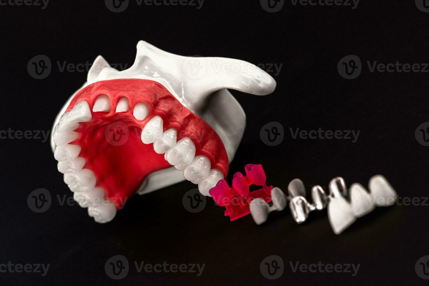 Teeth implant and crown installation process parts isolated on a black background. Medically accurate 3D model. photo