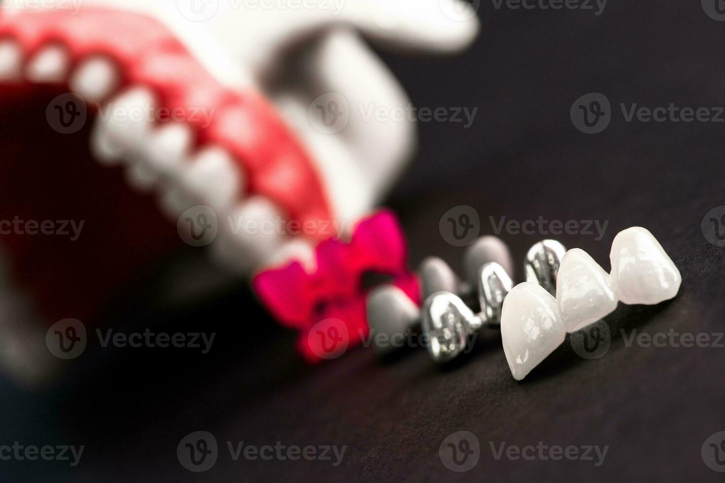 Teeth implant and crown installation process parts isolated on a black background. Medically accurate 3D model. photo
