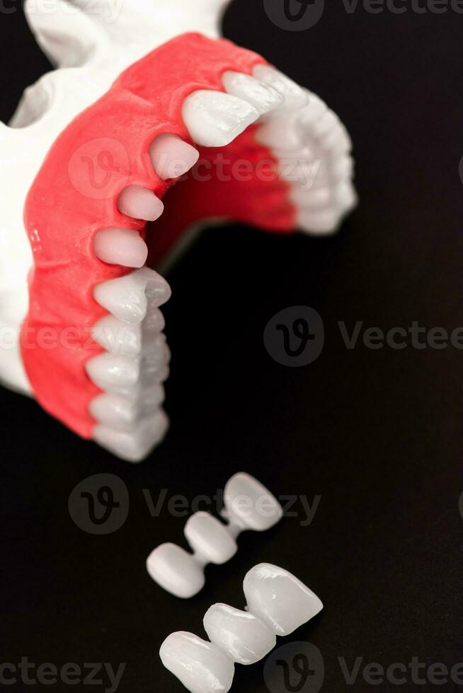 Teeth implant and crown installation process parts isolated on a black background. Medically accurate 3D model. photo
