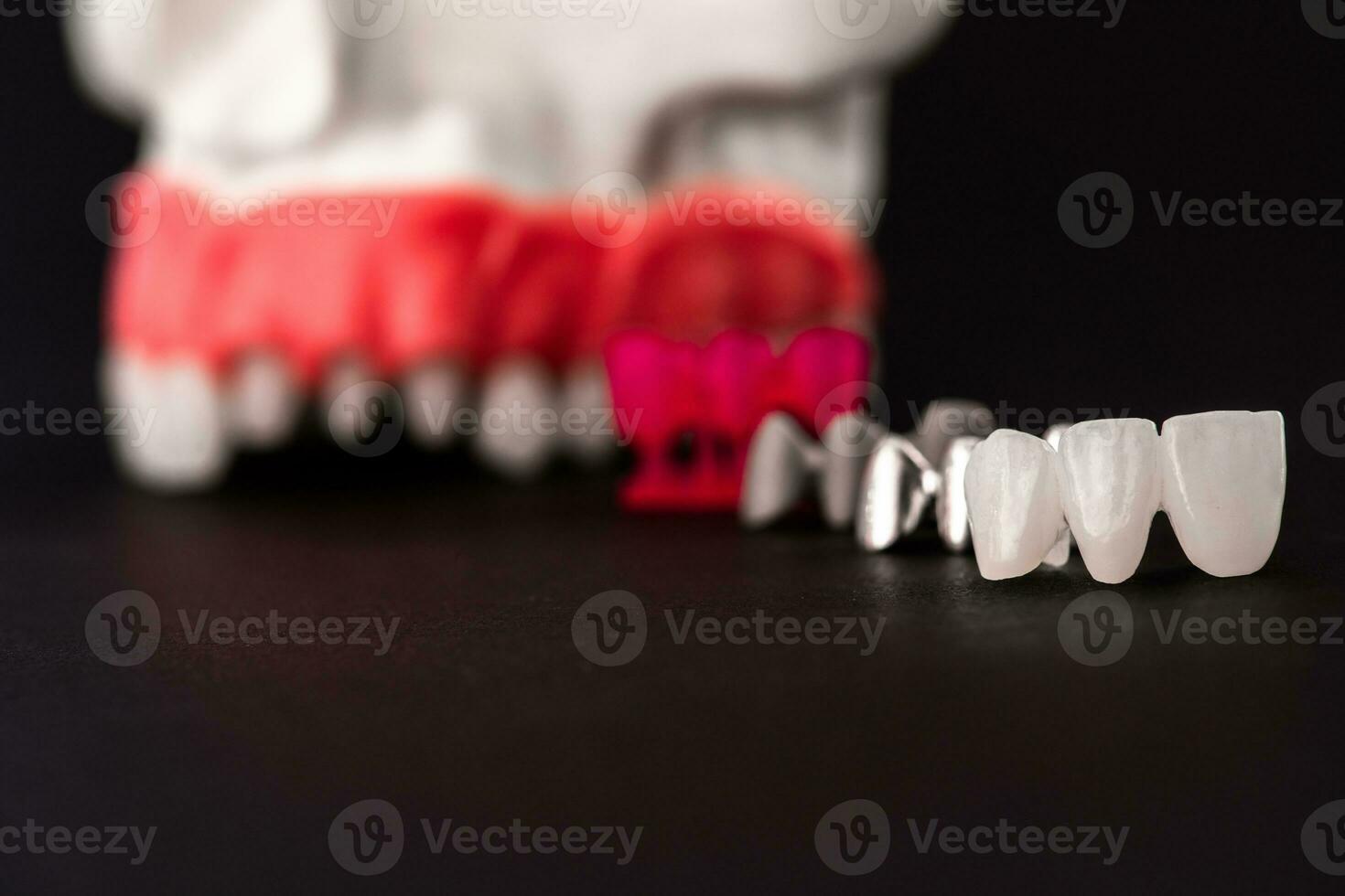 Teeth implant and crown installation process parts isolated on a black background. Medically accurate 3D model. photo