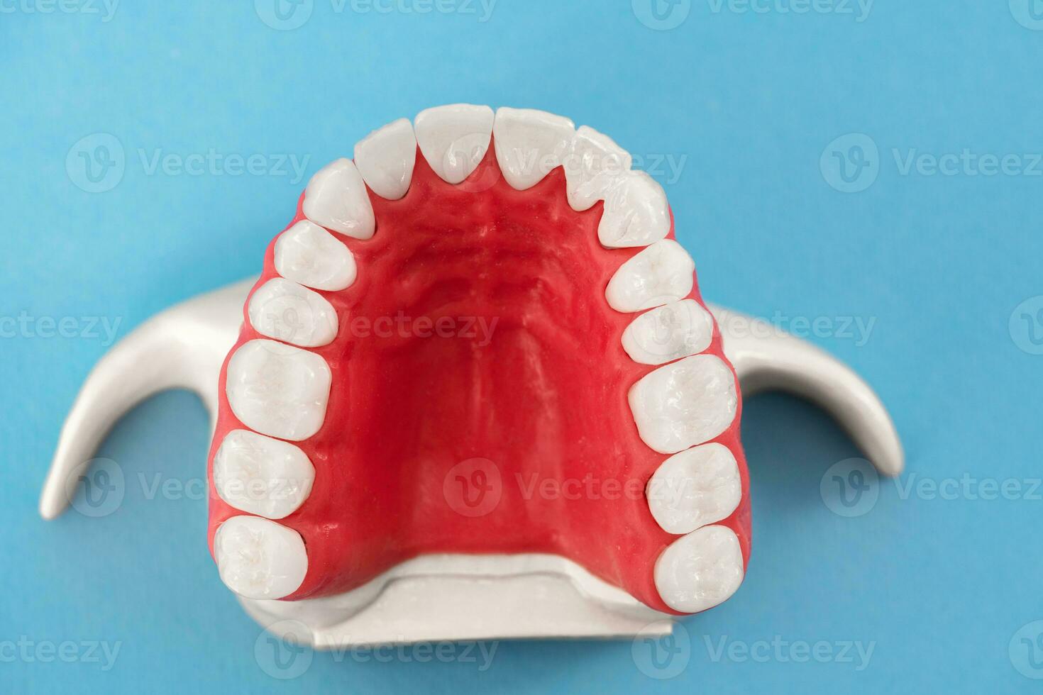 Teeth implant and crown installation process parts isolated on a blue background. Medically accurate 3D model. photo