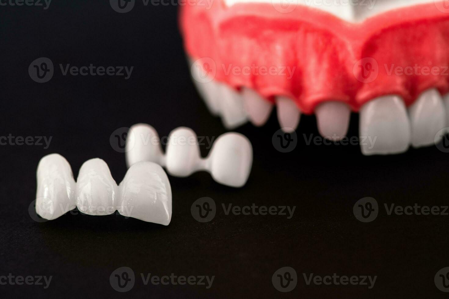 Teeth implant and crown installation process parts isolated on a black background. Medically accurate 3D model. photo