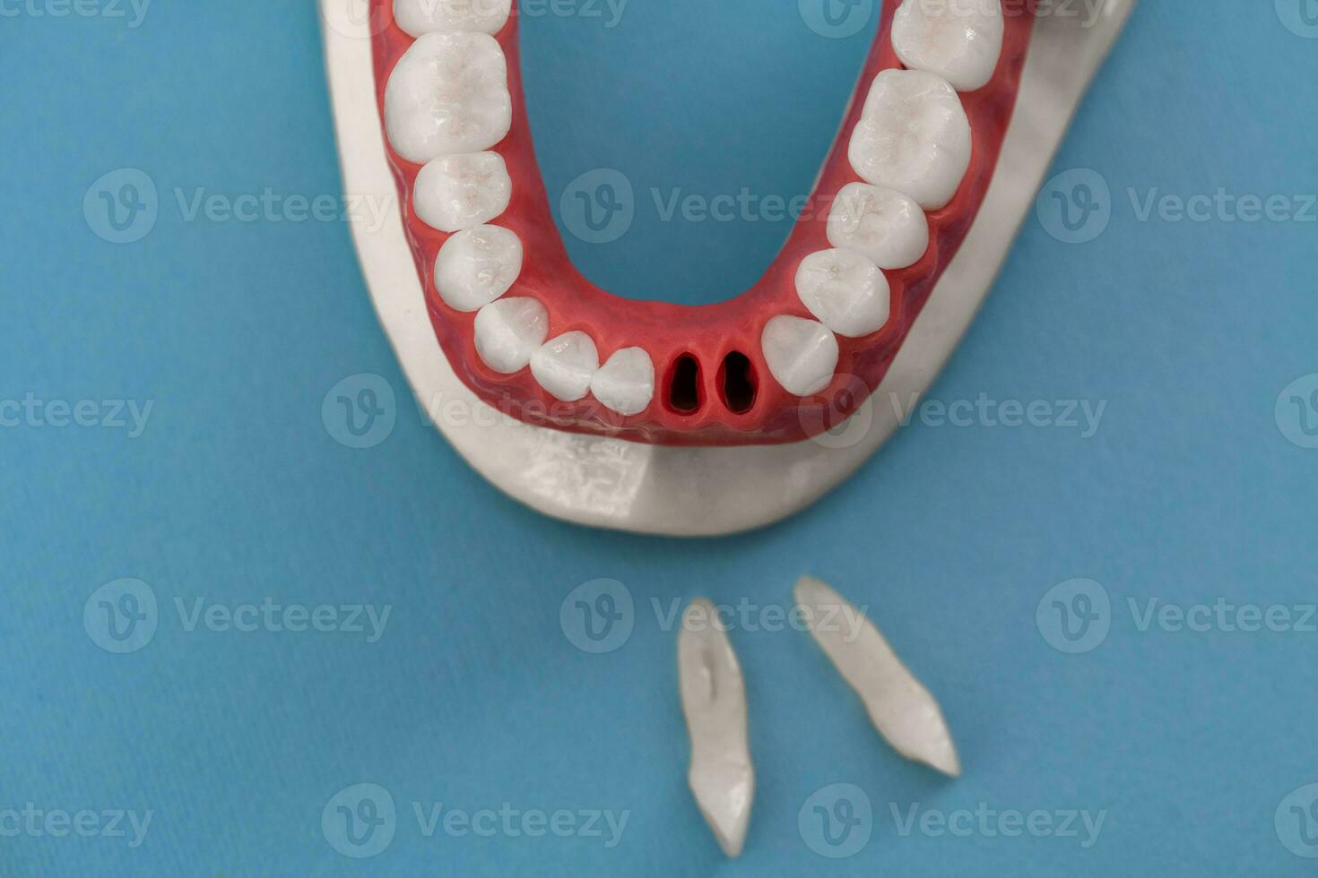 Teeth implant and crown installation process parts isolated on a blue background. Medically accurate 3D model. photo