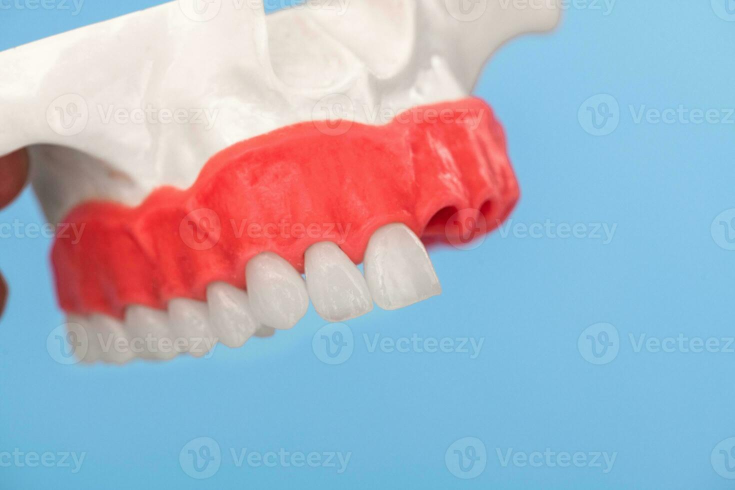 Teeth implant and crown installation process parts isolated on a blue background. Medically accurate 3D model. photo