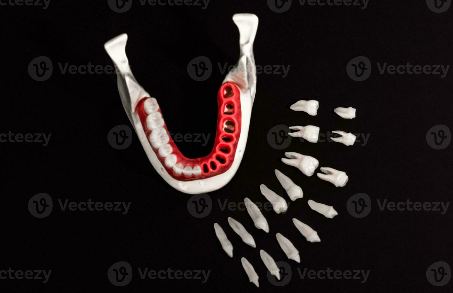 dientes implante y corona instalación proceso partes aislado en un negro antecedentes. médicamente preciso 3d modelo. foto