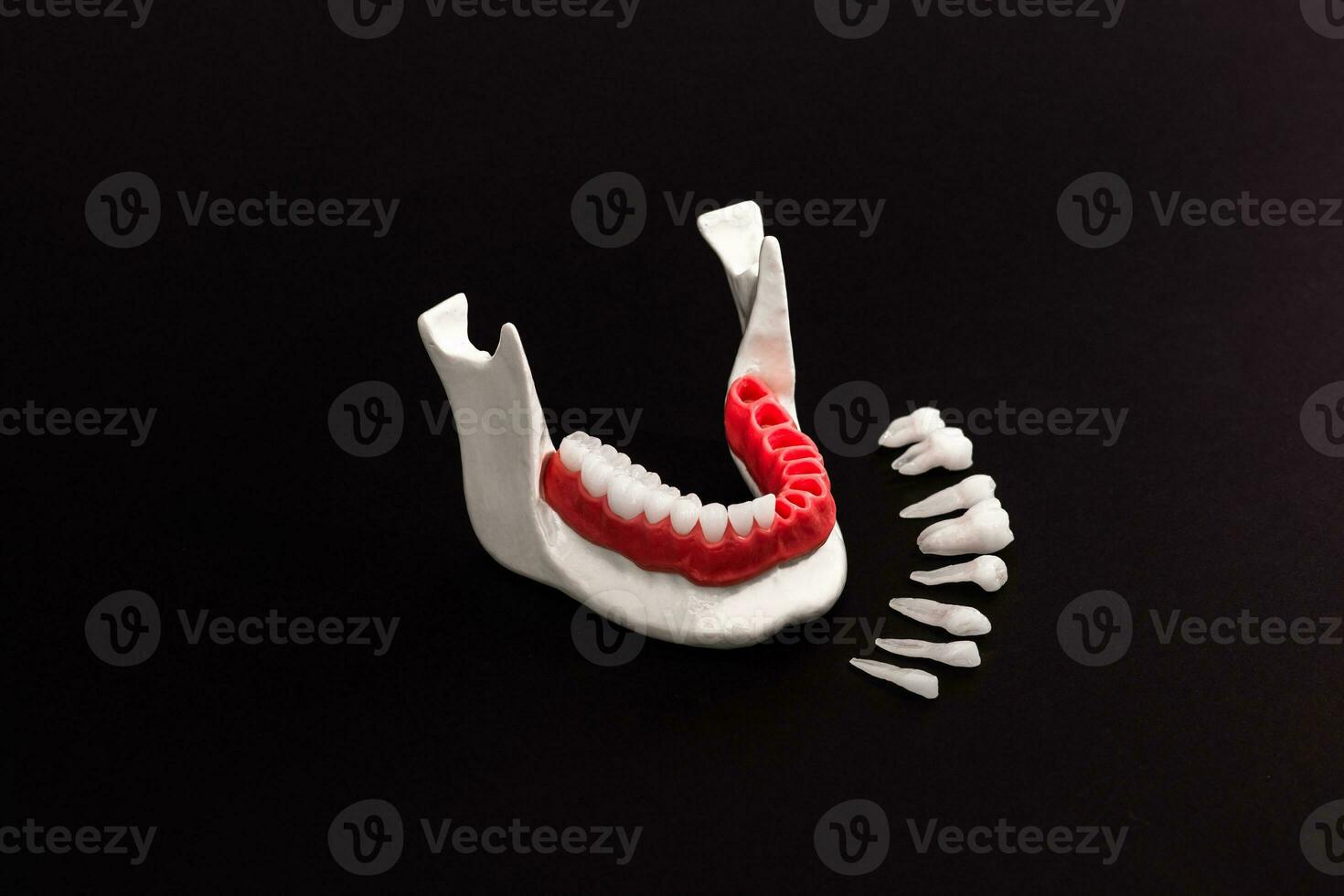 Teeth implant and crown installation process parts isolated on a black background. Medically accurate 3D model. photo