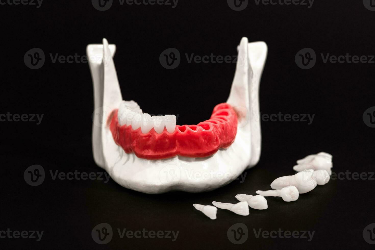 Teeth implant and crown installation process parts isolated on a black background. Medically accurate 3D model. photo