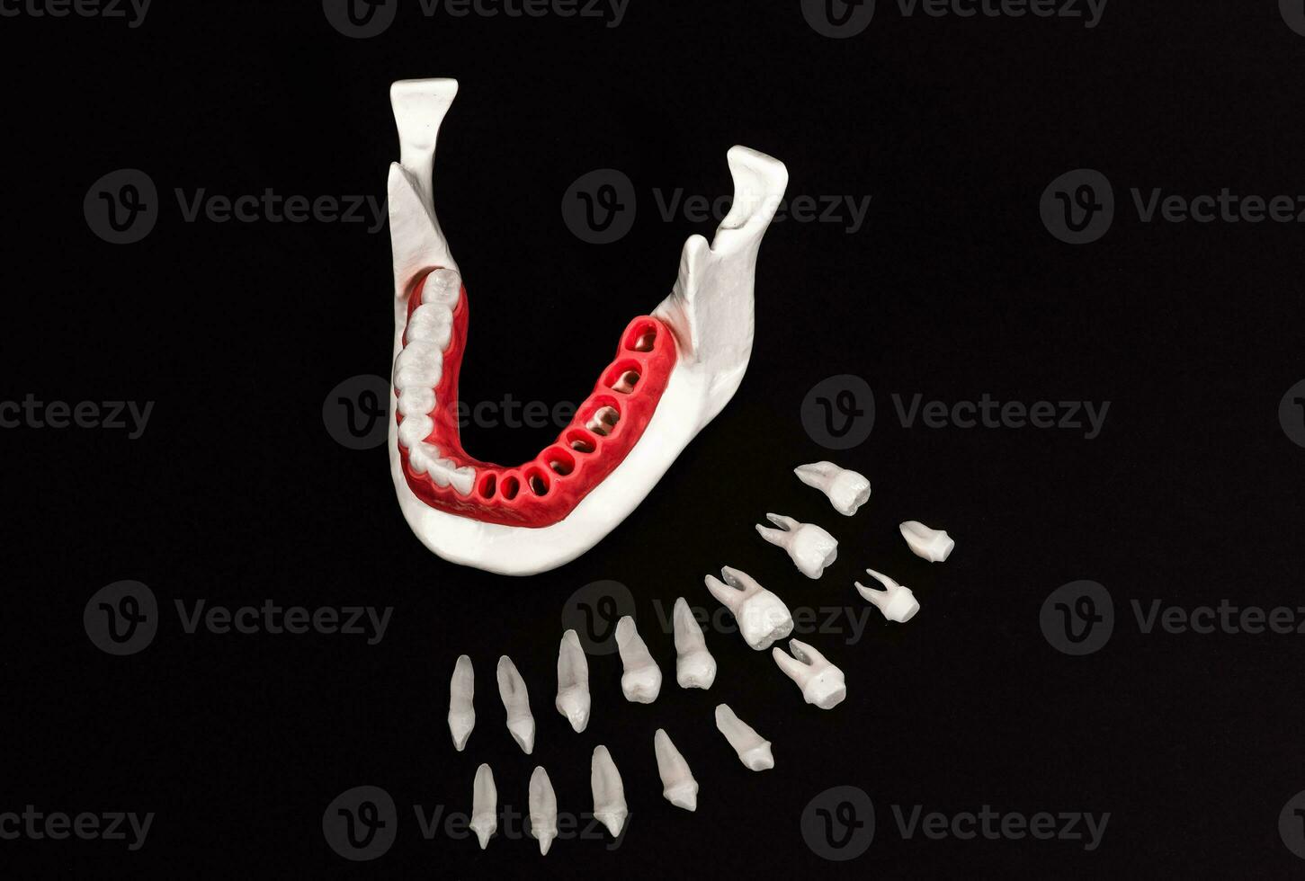 Teeth implant and crown installation process parts isolated on a black background. Medically accurate 3D model. photo