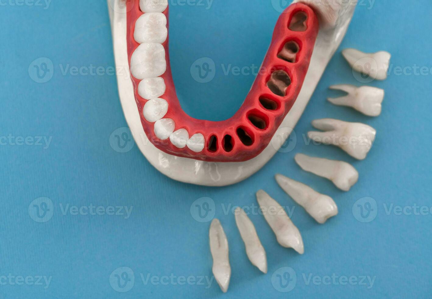 Teeth implant and crown installation process parts isolated on a blue background. Medically accurate 3D model. photo